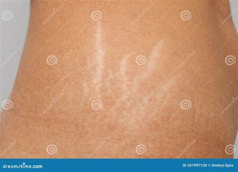 Legs And Thighs Stretch Marks at Lee Ramirez blog