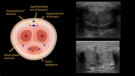 Ultrasound Penile Anatomy