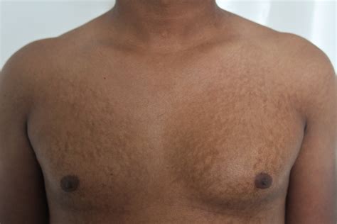 Confluent and reticulated papillomatosis of Gougerot–Carteaud in a ...