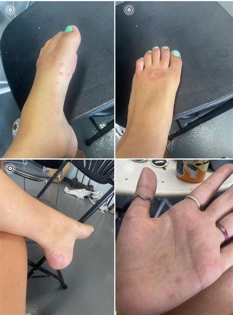 Large Itchy Bump On Foot at Frances Festa blog