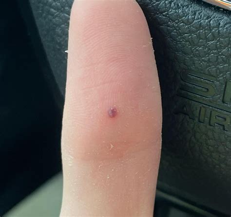 Mole On Finger