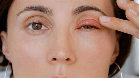 Chalazion Healing Stages - PEL
