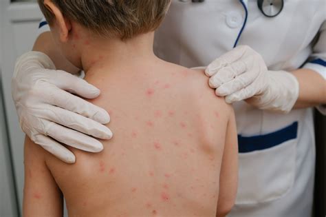 Warning to parents over the dangers of 'chicken pox parties'
