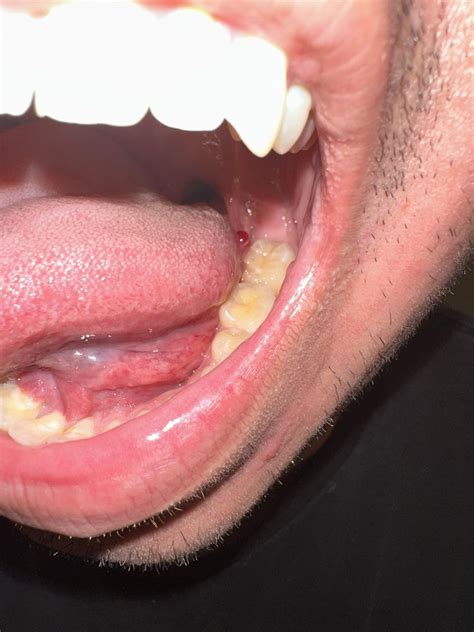 Bump on side of tongue : r/askdentists