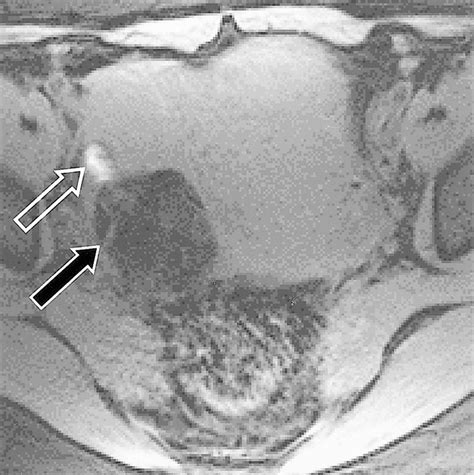 Ovarian Teratomas: Tumor Types and Imaging Characteristics | RadioGraphics