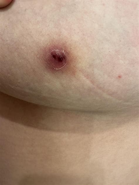 Weird bloody pimple on my chest that won’t go away : r/DermatologyQuestions