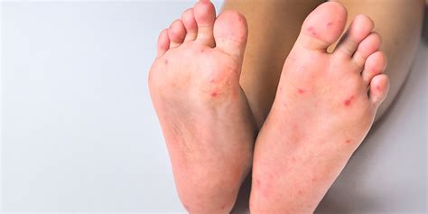 Hand-foot-mouth disease: everything a parent needs to know | Brunet