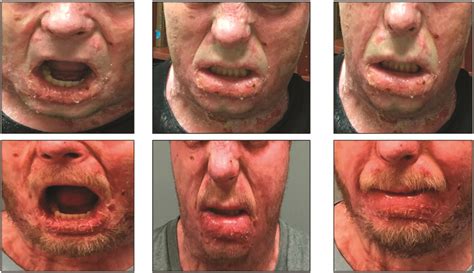 A Novel Adjunct for Treatment of Orofacial Contractures After a Facial ...