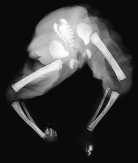 Twin reversed arterial perfusion (TRAP) sequence: an acardiac fetus ...