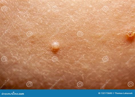 Close Up of Molluscum Contagiosum Also Called Water Wart Stock Photo ...