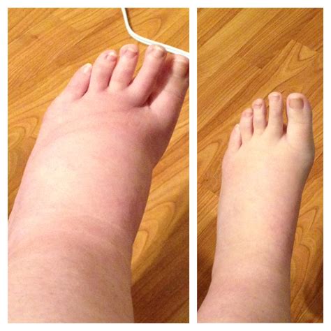 Pregnancy: Preeclampsia, ‘The silent killer’ – Queen of Fire