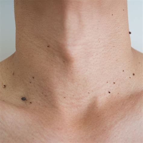 What Causes Moles On Your Skin? - LIFESTYLE BY PS