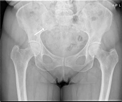 Insufficiency fractures of the sacrum | BMJ Case Reports
