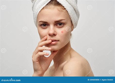 Attractive Woman with Towel on Head Naked Shoulders Pimples on Face ...