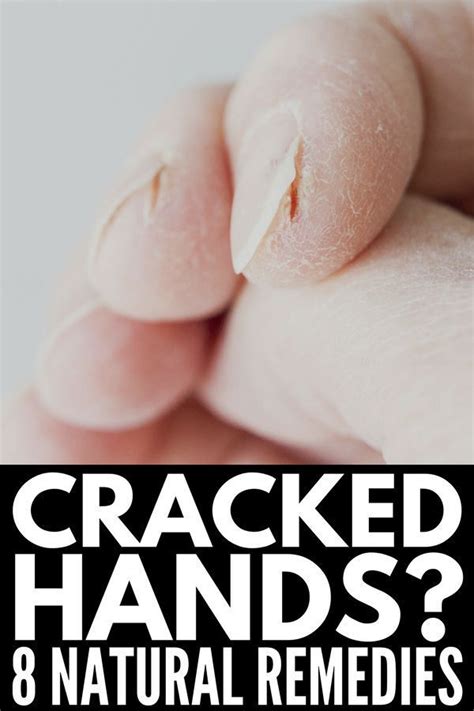 Severely Cracked Hands? 8 Tips & Remedies for Fast Relief | Dry cracked ...