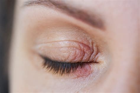 Eyelid dermatitis - Laboratoires Thea