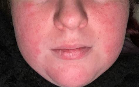 Help! My face (besides my forehead) is super red and patchy. It feels bumpy but isn’t painful ...