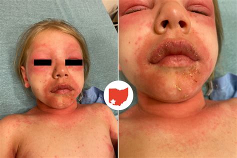 Staph Scalded Skin Syndrome