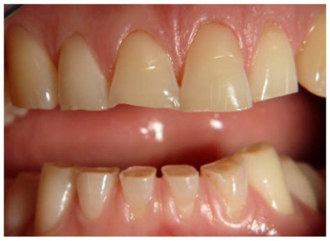 Tooth Wear management | Pearl Dental Clinic | Dentist in London