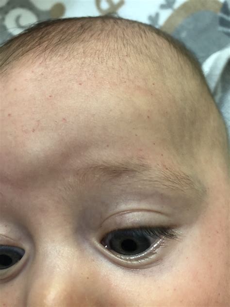 Small Red Spots On Face Child - Infoupdate.org