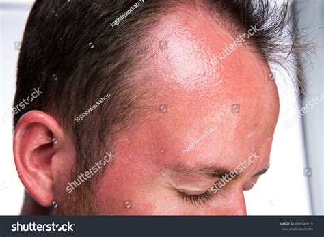 Sunburn Blisters On Face Sun Burn Swelling Blisters On Skin Stock