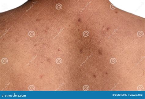 Dry Scars On The Back Of An Old Woman, Tan Separately On A White ...
