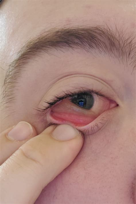 A case of chemosis caused by bacterial conjunctivitis (pink eye). This is my eye : r/medizzy
