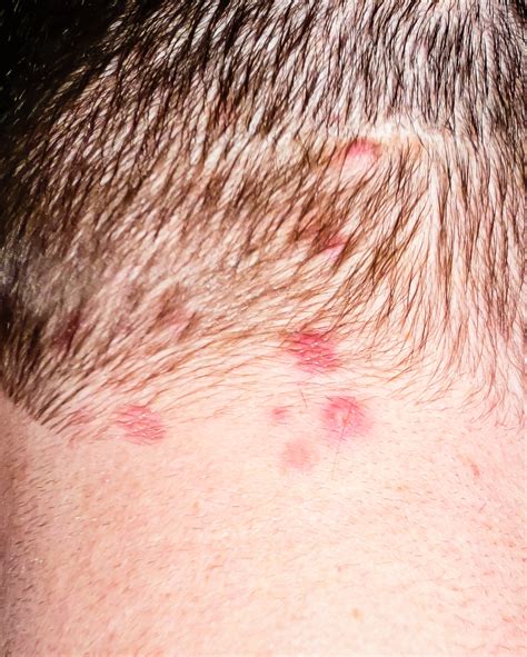 Dermatitis Herpetiformis - Symptoms, Causes & Treatment | Rash ID