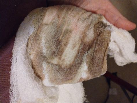 My xeroform turns black! : r/woundcare