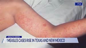 Measles cases rise in Texas, New Mexico