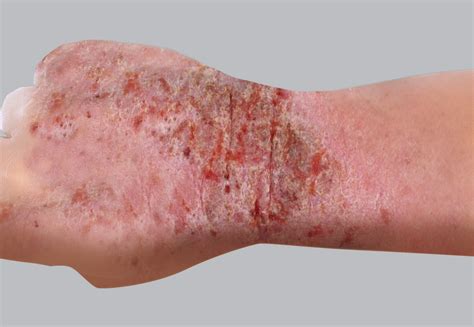 Eczema in adults | Eczema Foundation