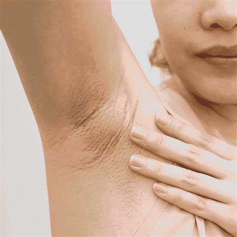 Dark Underarms Causes, Type, Symptoms & Treatment | USHC