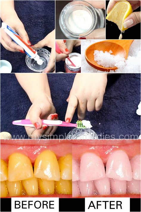 How To Make Teeth Whiter