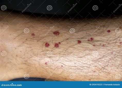 Vasculitis. Vasculitis in Legs. Small Red or Purple Spots. Rare Disease. Stock Image - Image of ...