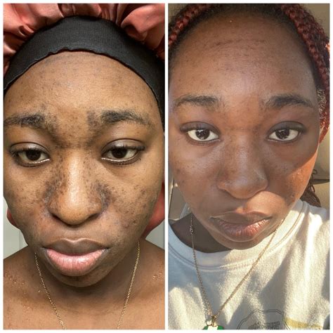 I’ve been using Tretinoin 0.5% since November 15, 2022. Although not consistently but here are ...