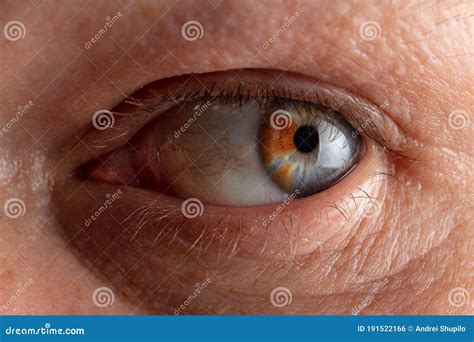 Close-up of a Manâ€™s Eye with a Birthmark on the Pupil Stock Photo ...