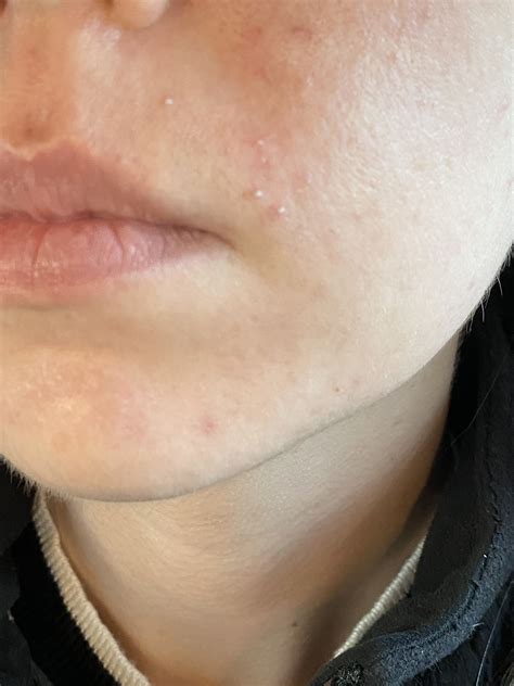 Gram Negative Folliculitis Face DermDx: Itchy Rash On Face And Neck