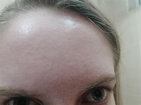 [skin concern] How do I get rid of these little bumps on my forehead? : r/Rosacea