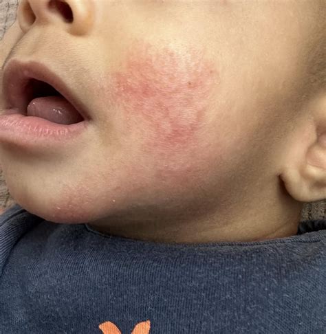 Drool Rash Vs Eczema at Tayla Burdett blog