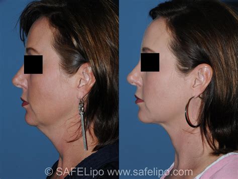 Double Chin Reduction Before and After Pictures Case 349 | SAFELipo®