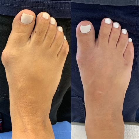 Bunion Corrector Before And After Pictures at Christina Aguirre blog