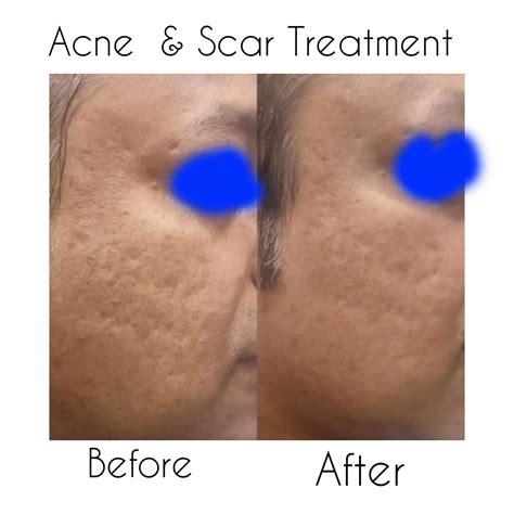Best Acne Scars Treatment in Kolkata - Cost, Procedures & Results - La Derma