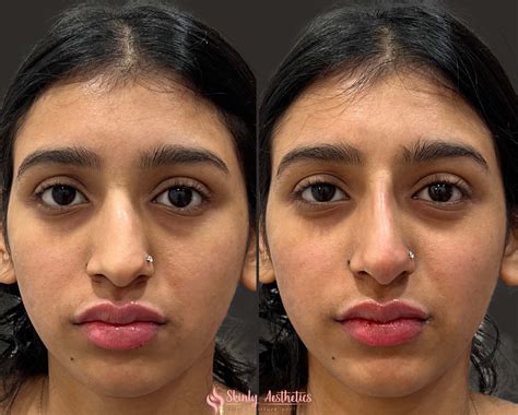 Nose Fillers Before And After
