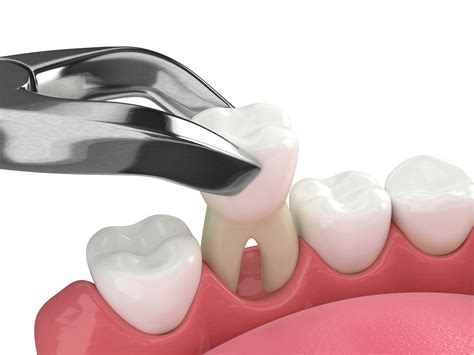Recovery Tips and Aftercare Following Tooth Extraction