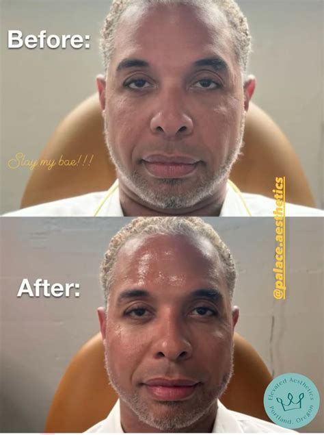 Collagen Biostimulators - Elevated Aesthetics