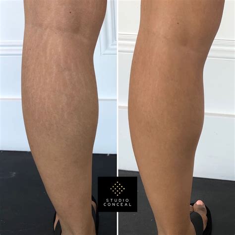 Legs And Thighs Stretch Marks at Lee Ramirez blog