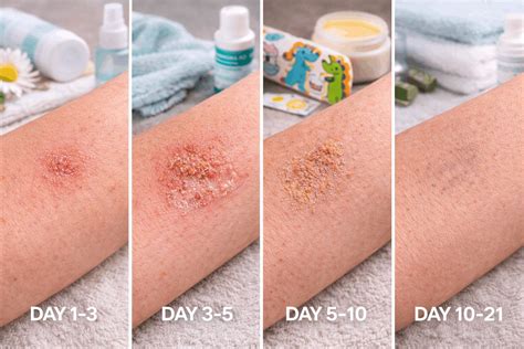 Contact Dermatitis Healing Stages