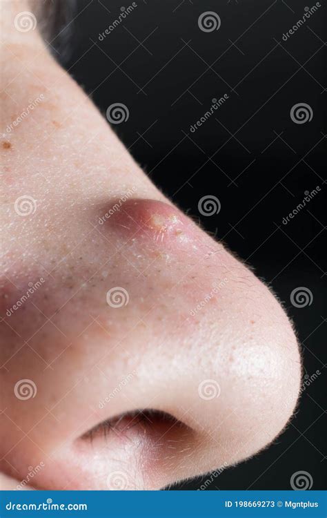 Large pimple on the nose stock image. Image of person - 198669273