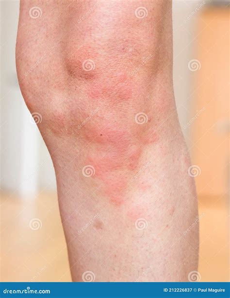 Urticaria Afección De La Piel Alergia De La Piel Al Cuerpo Uk Imagen de archivo - Imagen de ...