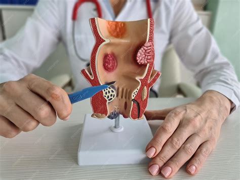 Preparation for surgery to remove hemorrhoids closeup | Premium Photo